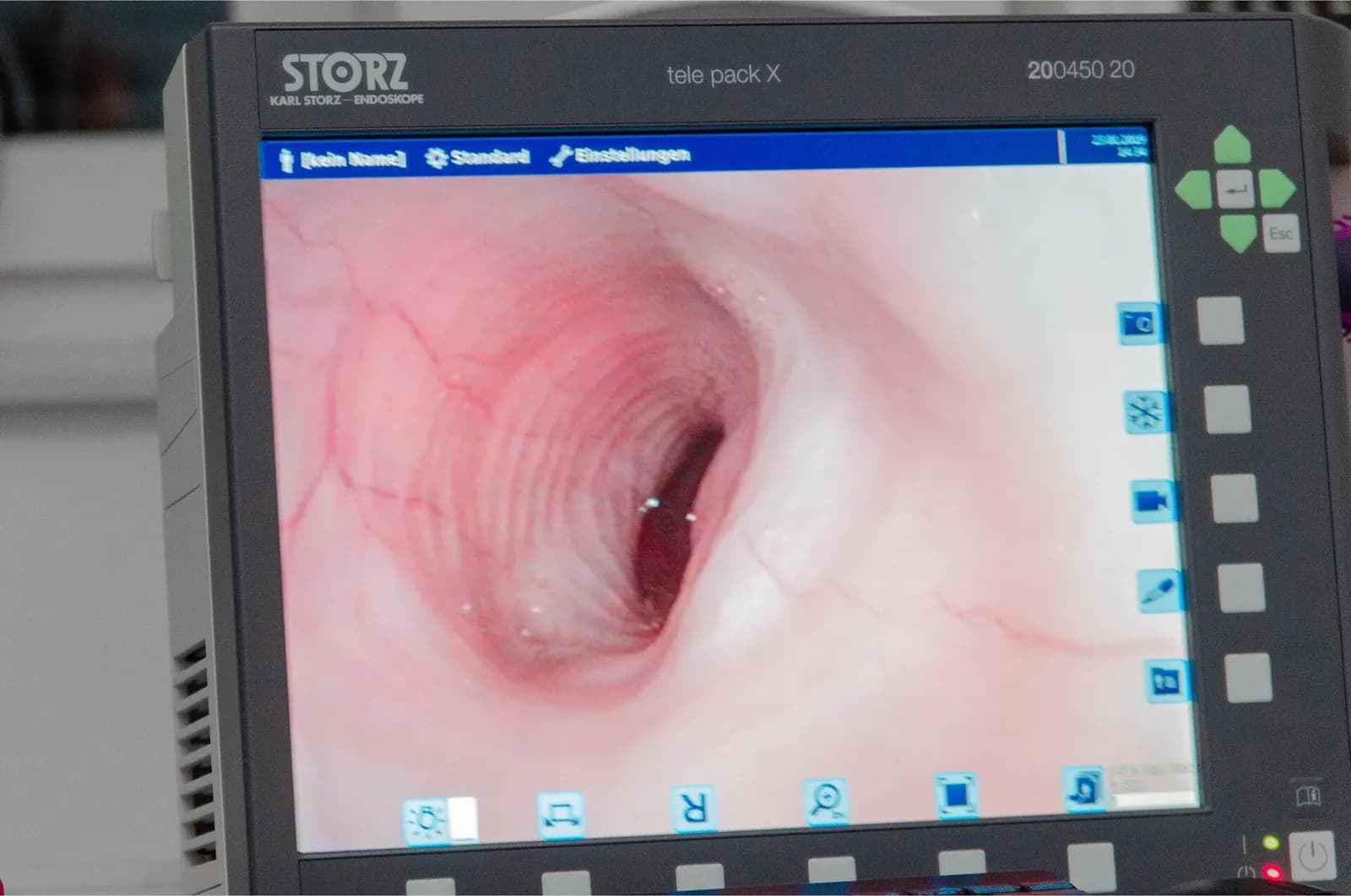Endoskopiebild auf dem Monitor des Videoendoskopie-Turms